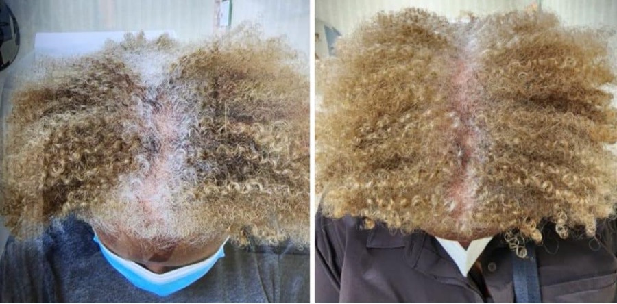 Before and after six weeks of Revian Red use. Photos courtesy of Dr. Dina Strachan, Aglow Dermatology.